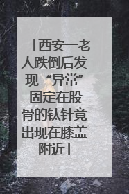 西安一老人跌倒后发现“异常” 固定在股骨的钛针竟出现在膝盖附近